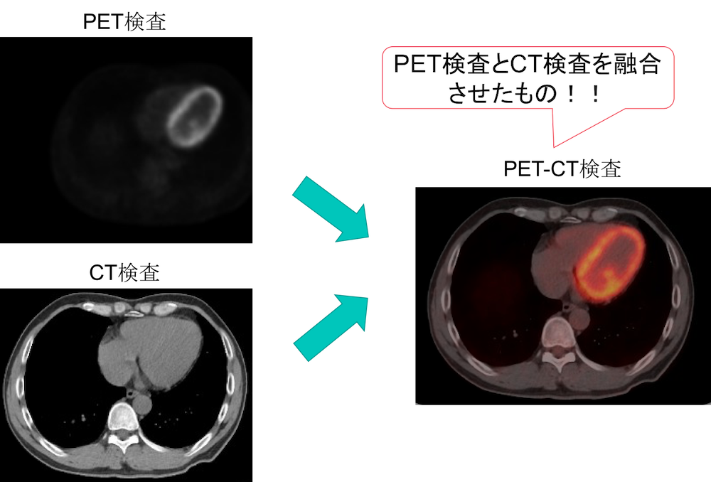 PET-CT findings