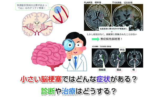 小さい脳梗塞ではどんな症状がある？診断や治療はどうする？