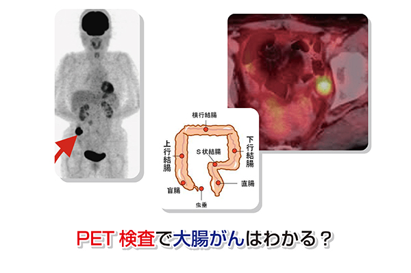 PET検査で大腸がんはわかる？