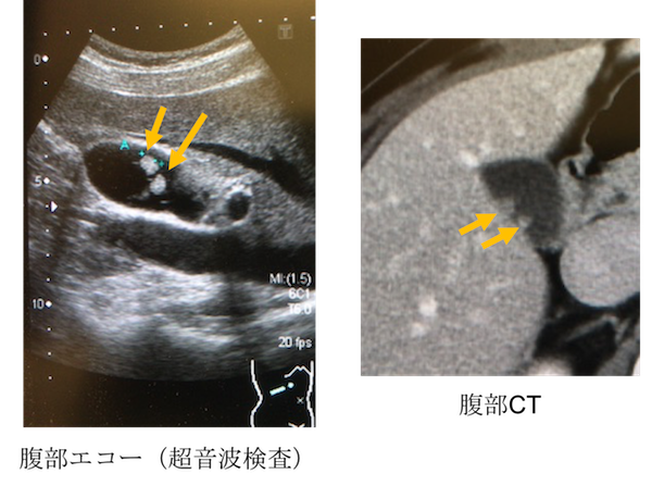 gallbladder polyp echo and CT findings