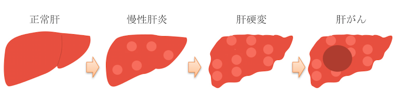 liver LC HCC