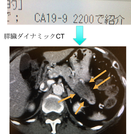 pancreatic cancer ct findings