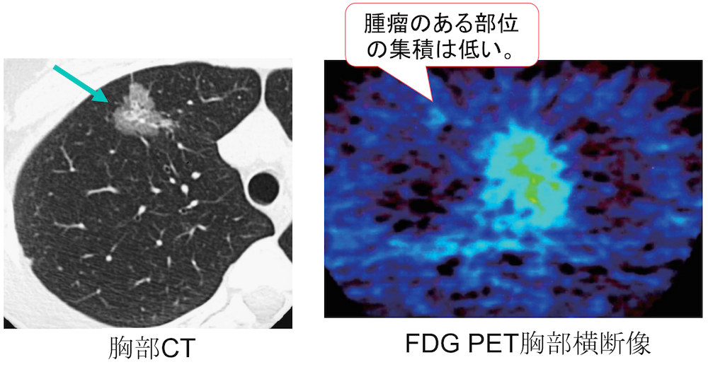 well differentiated lung cancer fdg pet CT findings
