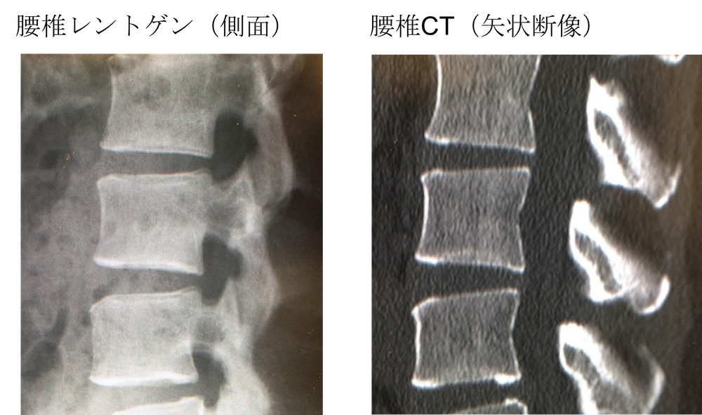 osteoporosis Xray and CT findings