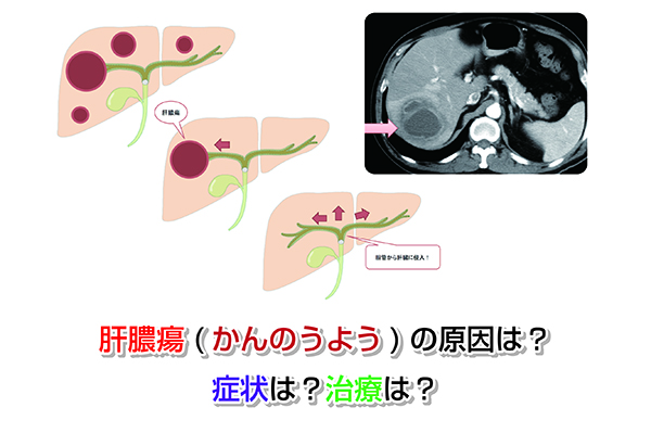 【CT画像で解説】肝膿瘍(かんのうよう)の原因・症状・治療！