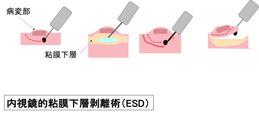 Endocscopic Submucosal Dissection