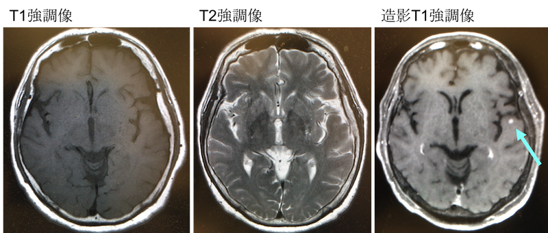 brain metastasis contrast mri findings