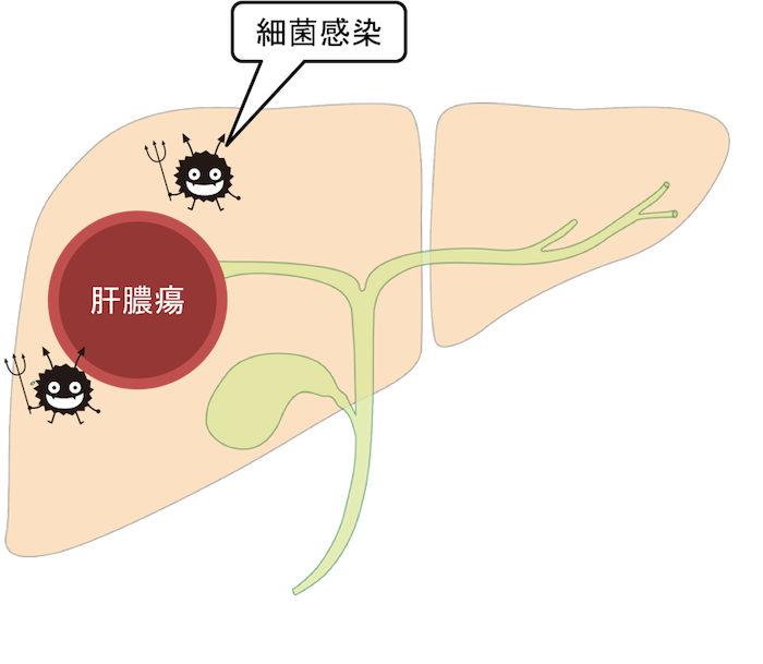 liver abscess figure1