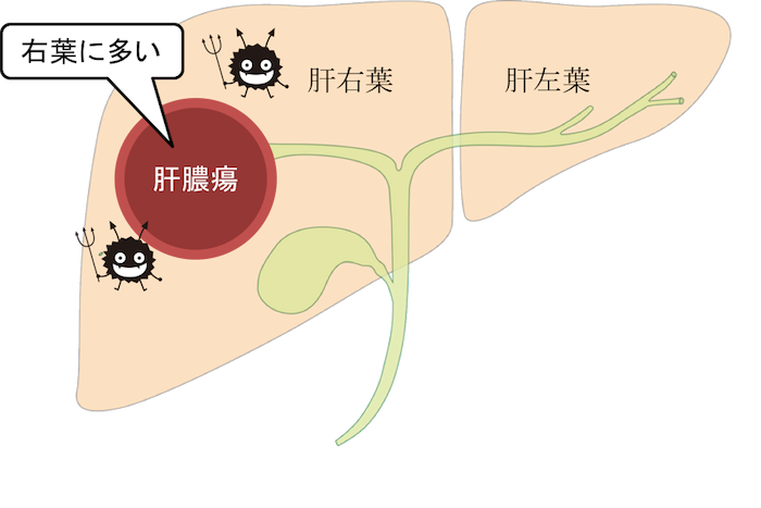 liver abscess figure2