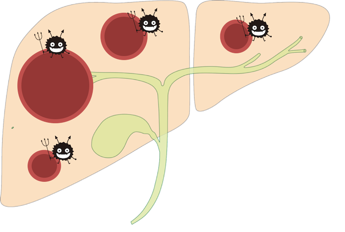 liver abscess figure4