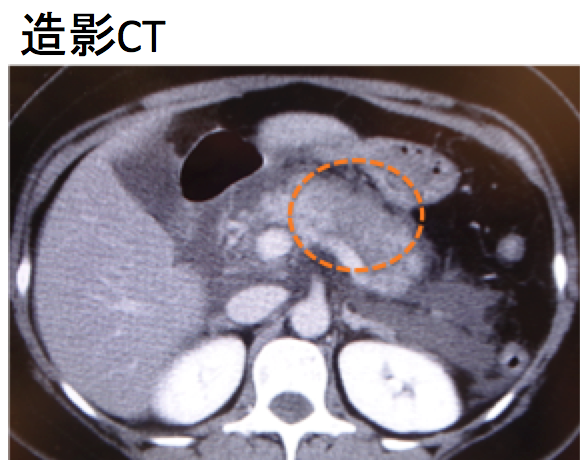 pancreatitis CT