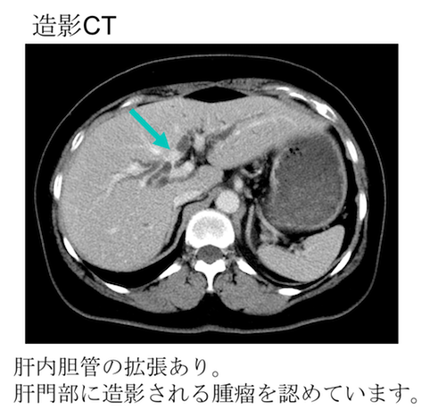 Cholangiocarcinoma CT findings