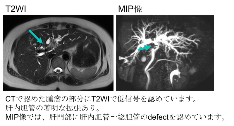 Cholangiocarcinoma MRI findings