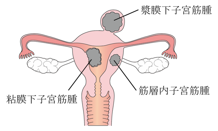 kinds of uterus myoma