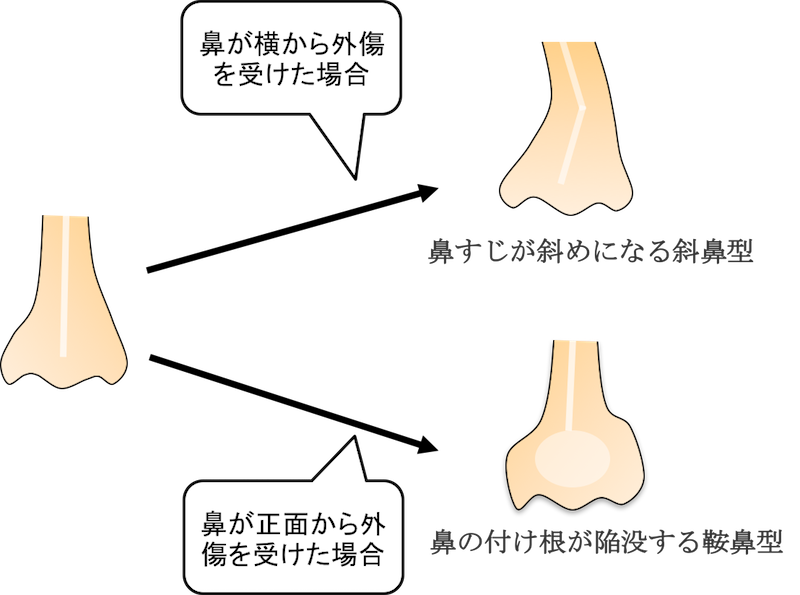 nasal fracture figure1