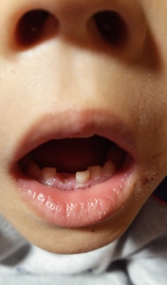 子供の歯が折れたらどうしたらいい？