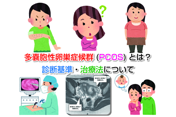 多嚢胞性卵巣症候群(PCOS)とは？診断基準・治療法について
