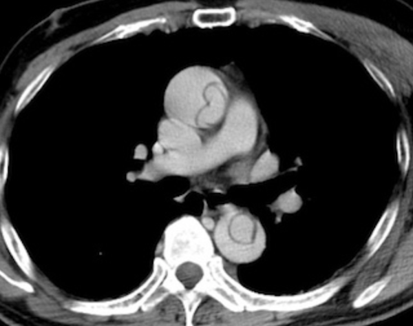 aortic dissection