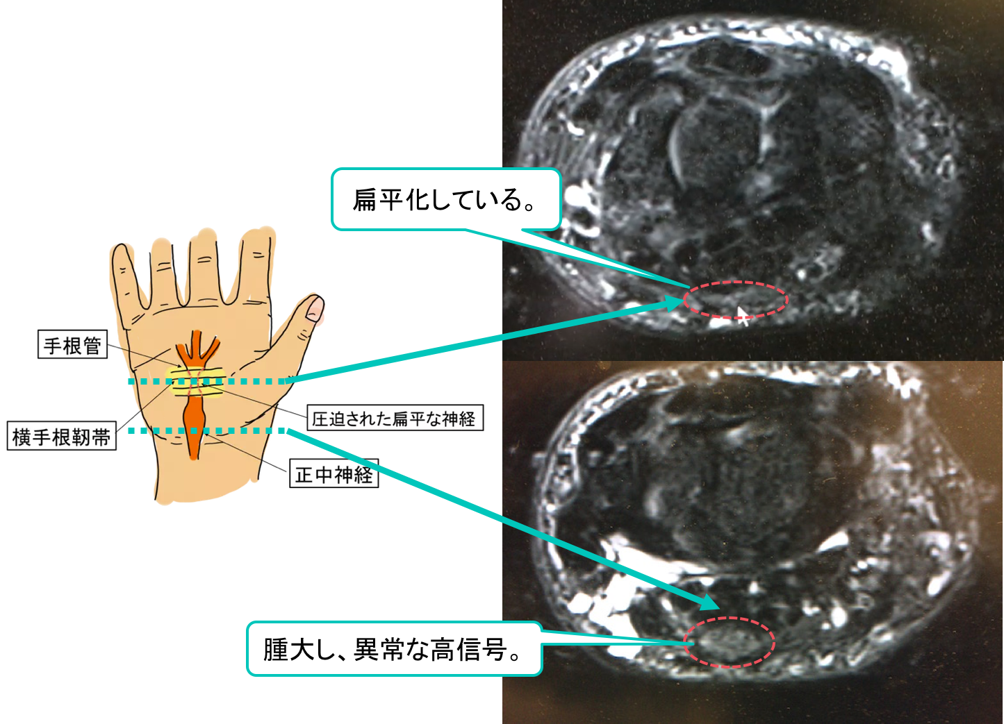 carpal-tunnel-syndrome-mri-findings1