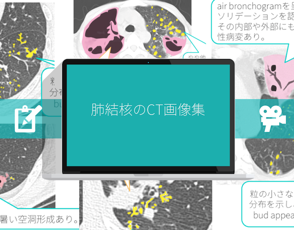 【保存版】肺結核のCT画像7選！特徴的な所見はこれ！