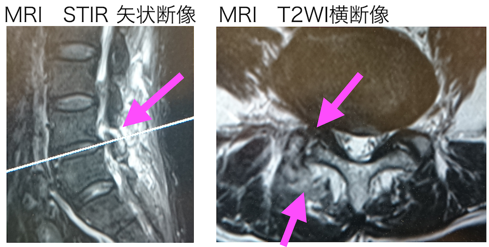 化膿性椎間関節炎とは？症状からMRI画像まで。
