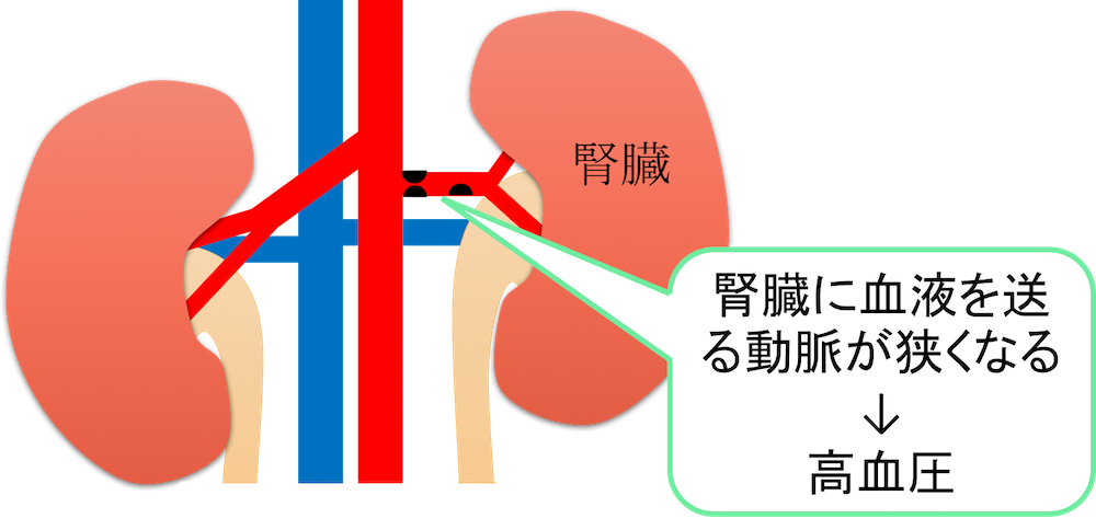 renovascular hypertension figure