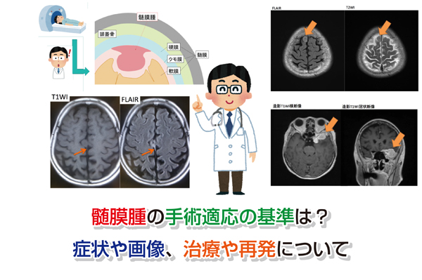 【CT,MRI画像あり】髄膜腫の手術適応の基準は？症状や治療、再発まとめ