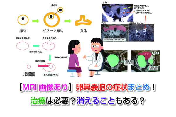 【MRI画像あり】卵巣嚢胞の症状まとめ！治療は必要？消えることもある？