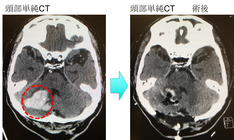 cerebellar hemorrhage CT findings1