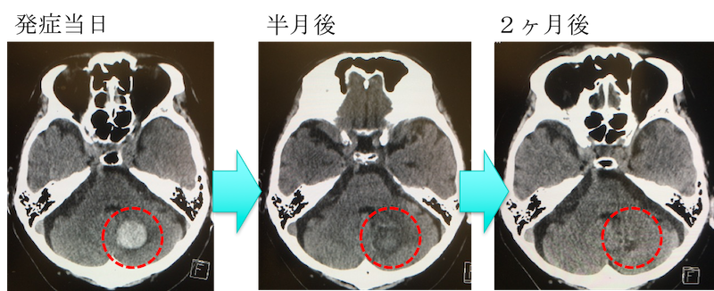 cerebellar hemorrhage CT findings2