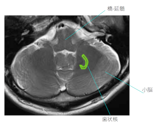 cerebellar hemorrhage　doc1