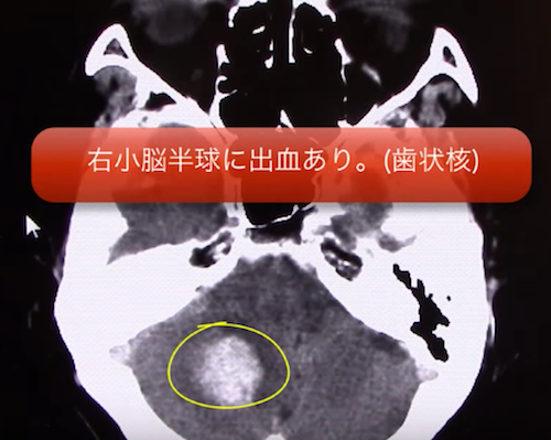 cerebellar hemorrhage1