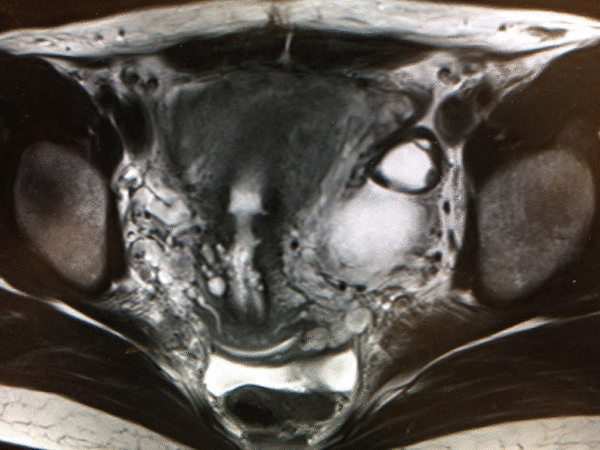 functional ovarian cyst figure