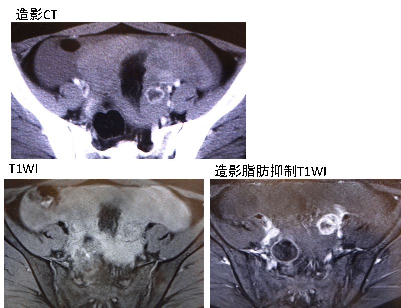 functional ovarian cyst rupture mri findings