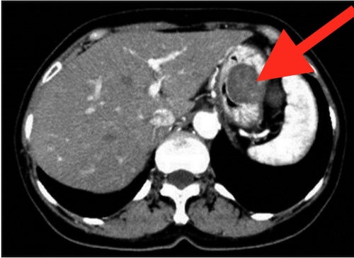 gist CT findings