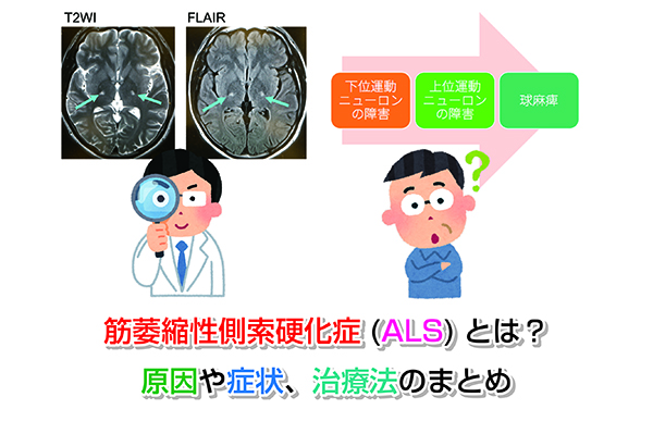 【MRI画像あり】筋萎縮性側索硬化症(ALS)とは？原因や症状、治療法まとめ