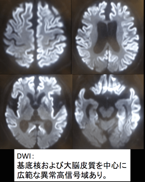 cjd　MRI doc1