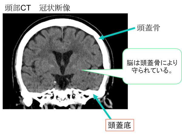 Basal skull CT findings