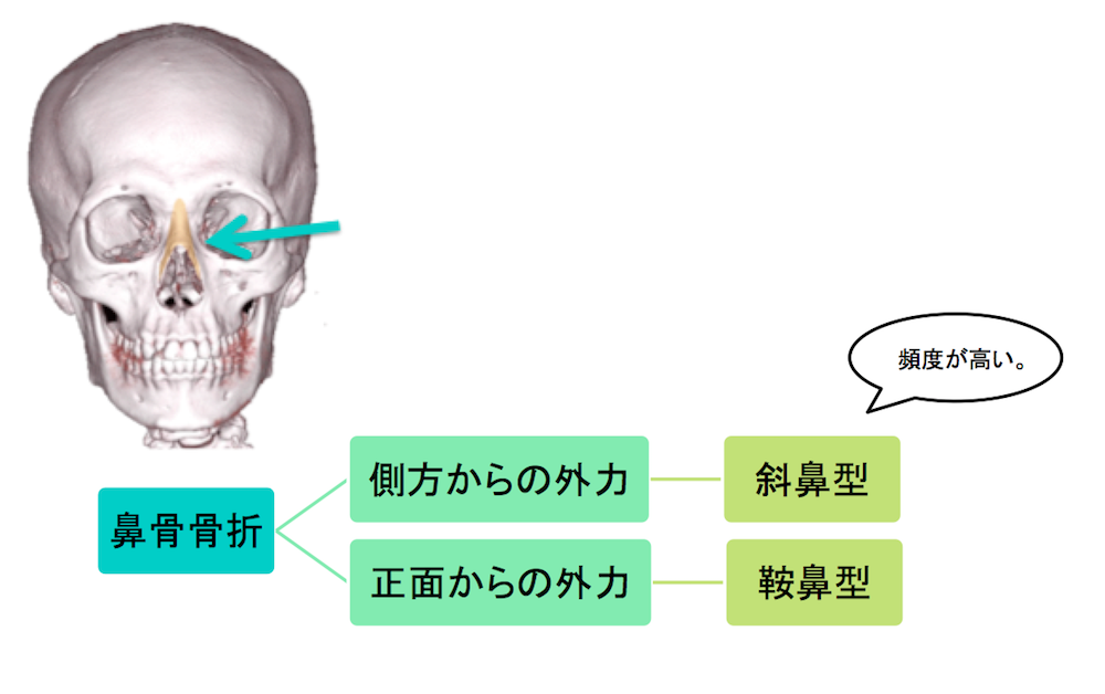 nasal-bone-fracture-classification