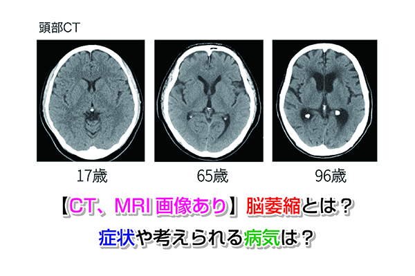 【CT、MRI画像あり】脳萎縮とは？症状や考えられる病気は？