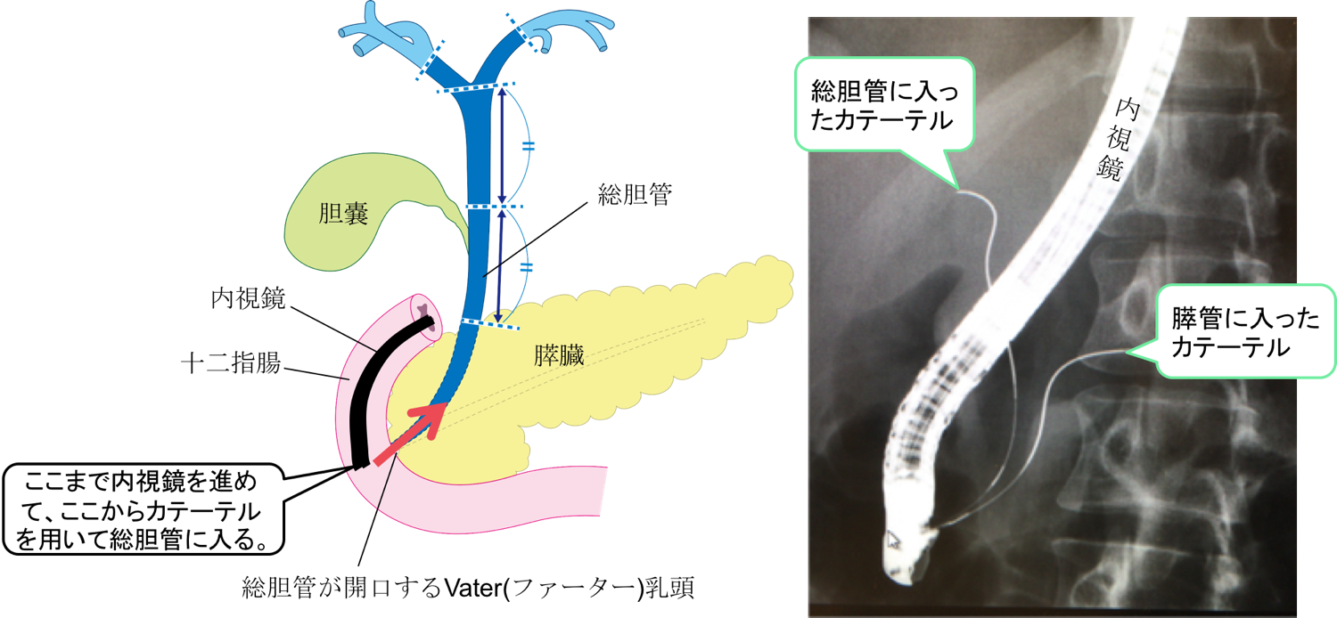 endoscopic-retrograde-cholangiopancreatography