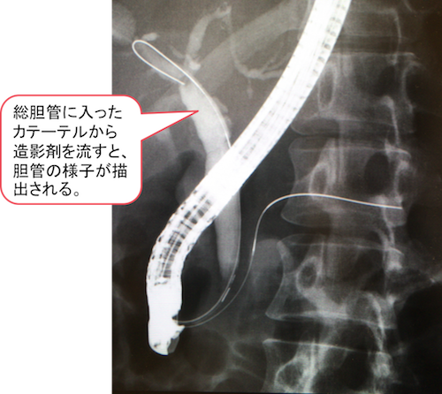 endoscopic-retrograde-cholangiopancreatography1