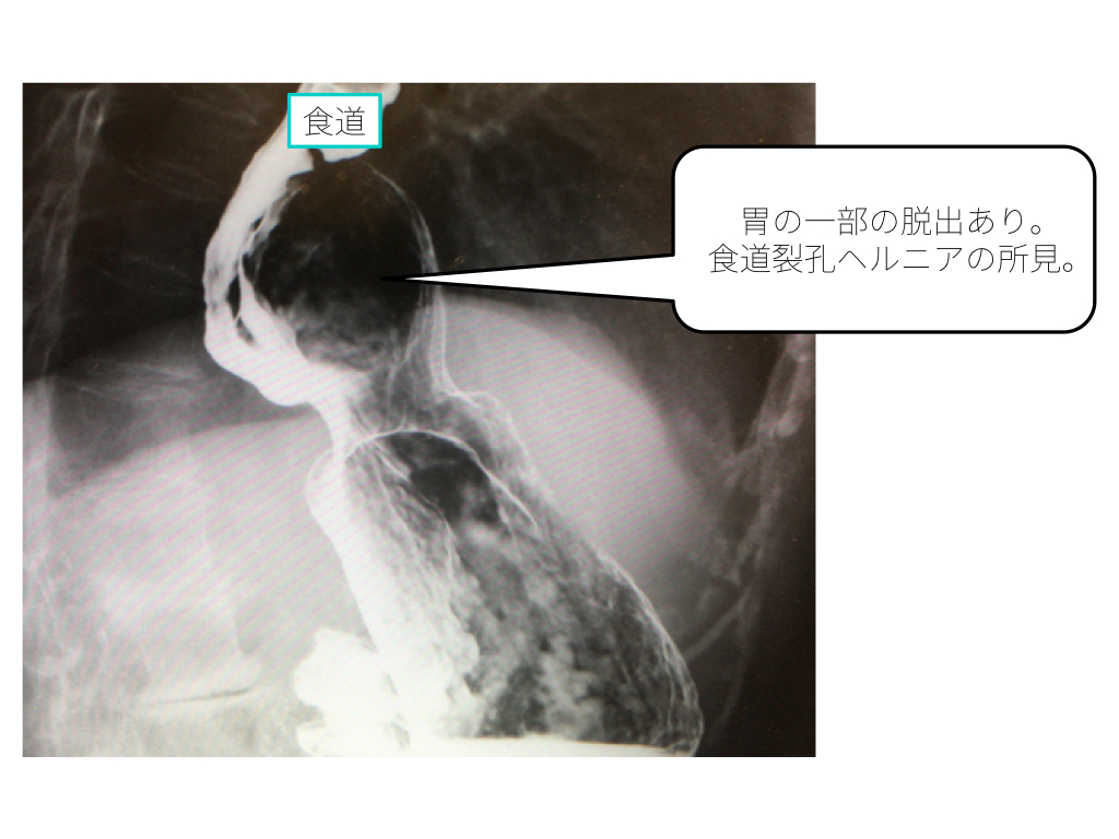 esophageal-hiatal-hernia-001　doc