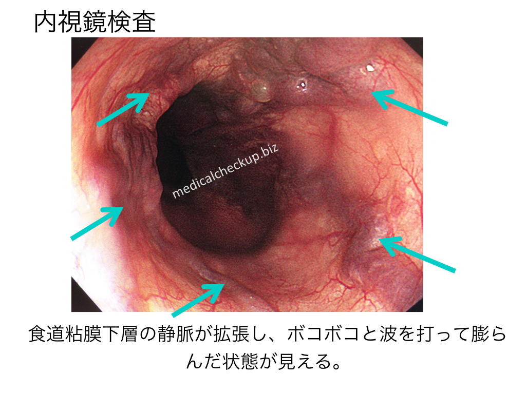 esophageal-varices-001