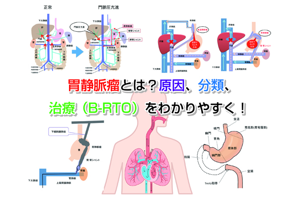 Gastric varices Eye-catching image