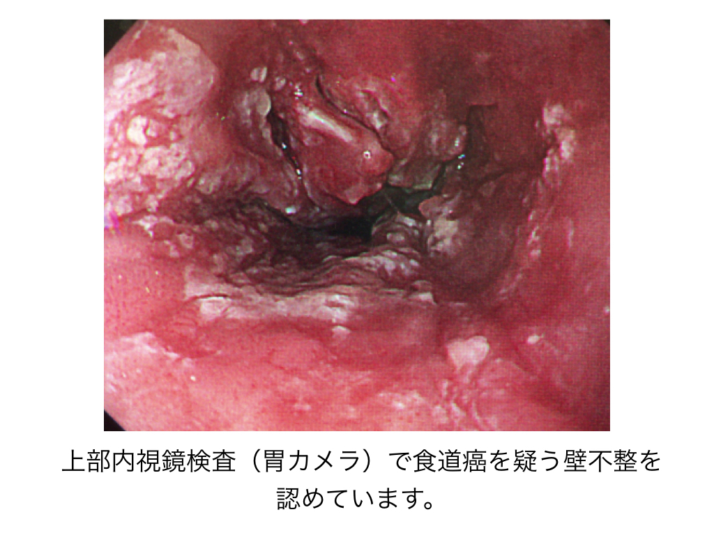 esophageal-cancer-001
