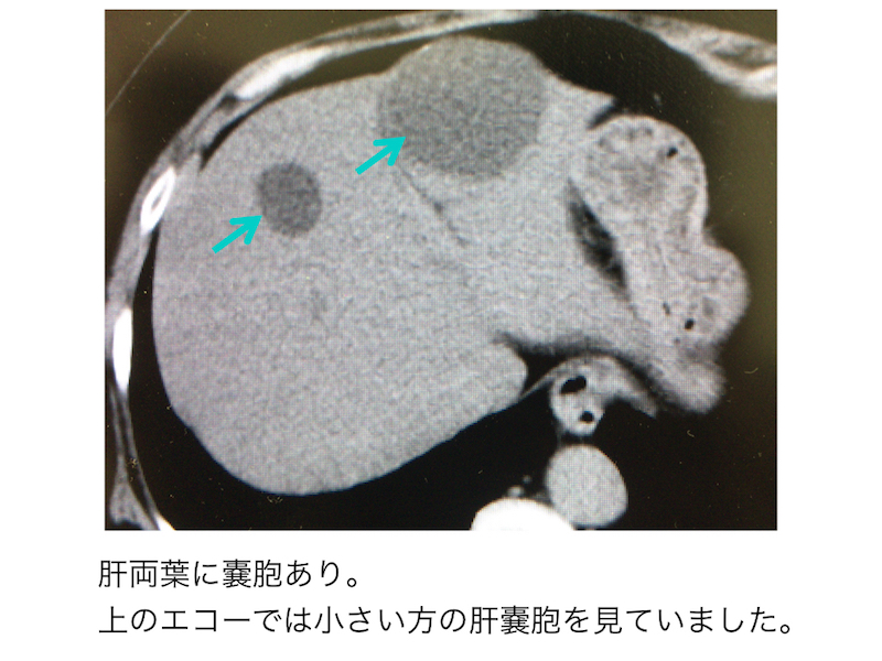 hepatic-cyst-002