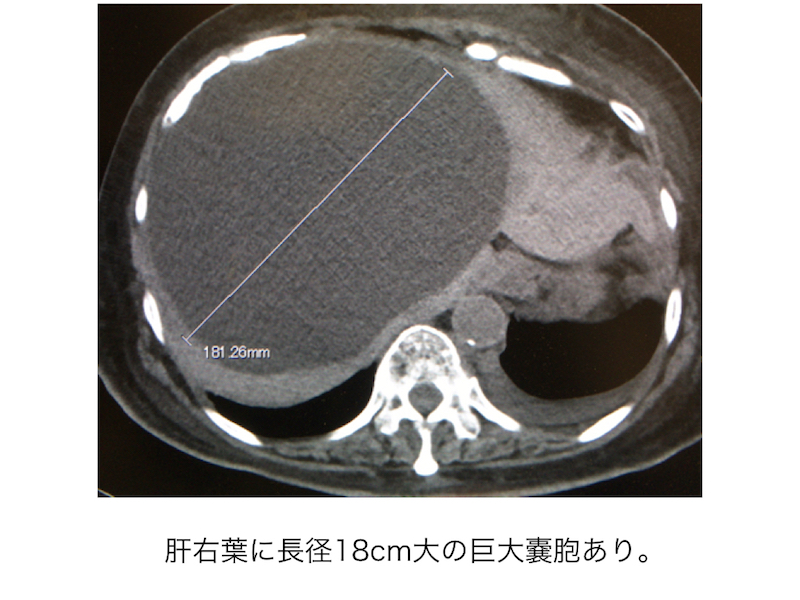 hepatic-cyst-003　doc2