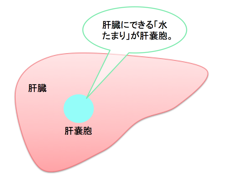 hepatic-cyst