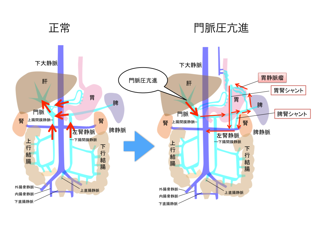 portal-hypertension-001